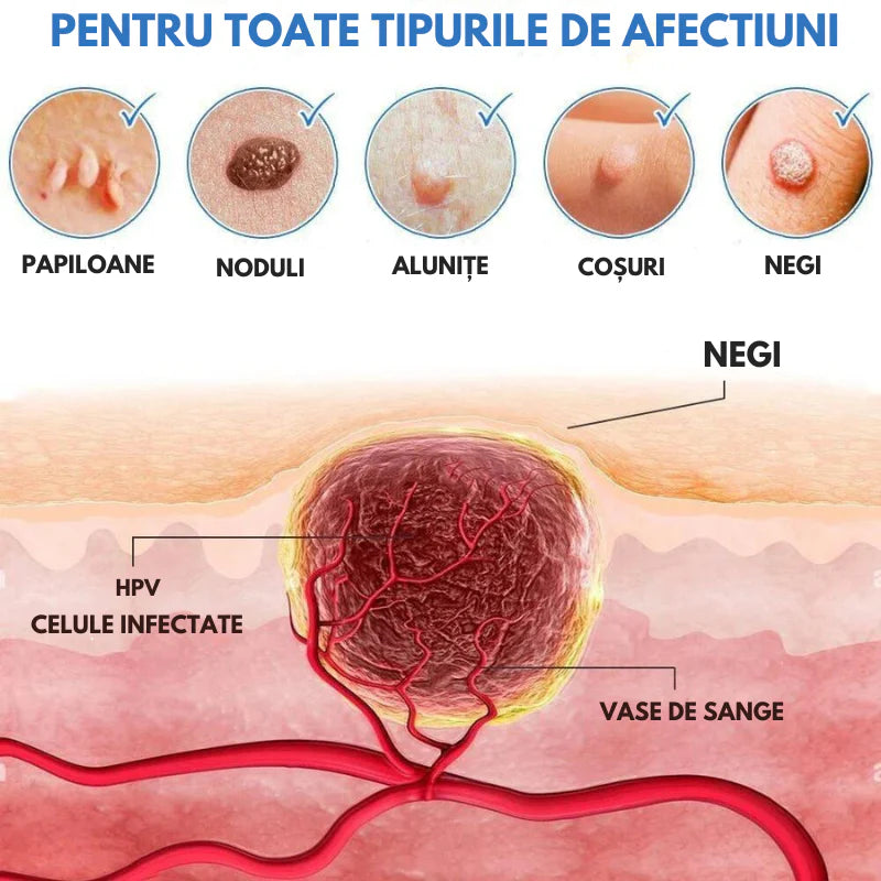 ClearSkin WartOff Cream – Eliminare Rapidă a Negilor și Imperfecțiunilor Pielea Fără Durere