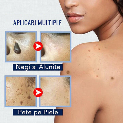 ClearSkin WartOff Cream – Eliminare Rapidă a Negilor și Imperfecțiunilor Pielea Fără Durere