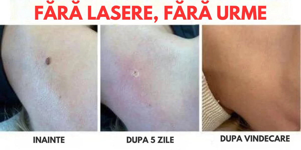 ClearSkin WartOff Cream – Eliminare Rapidă a Negilor și Imperfecțiunilor Pielea Fără Durere
